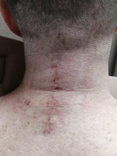 Post-Surgical Recovery Following Spinal Injury Post-surgical spinal cord injury scar